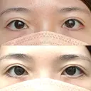 目尻切開 / タレ目形成・グラマラスライン（切開） 銀座高須クリニック DAY 379 サムネイル用