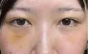 クマ治療 / 下まぶたたるみ取り / 下まぶたの脂肪取り APOLLO BEAUTY CLINIC DAY 7 サムネイル用