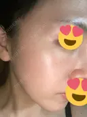 光治療（フォトフェイシャルなど） トラスト美容クリニック 銀座院 DAY 0 サムネイル用