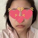 バッカルファット除去 / 脂肪吸引（顔） / メーラーファット除去 / ヒアルロン酸注入（あご） PRISM Beauty Clinic 町田院 DAY 1 サムネイル用