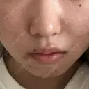ヒアルロン酸注入（鼻翼基部） ジョウクリニック 大阪院 AFTER サムネイル用