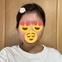 糸リフト / 脂肪吸引（顔） / ヒアルロン酸注入（あご） Wing clinic 豊中駅前院 DAY 2 サムネイル用