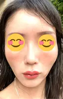 ヒアルロン酸注入（頬） 百人町アルファクリニック DAY 3 サムネイル用