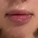 口唇縮小術 Kono Clinic AFTER サムネイル用