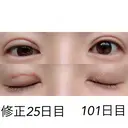 二重埋没 / 目元修正 湘南美容クリニック 広島院 DAY 25 サムネイル用