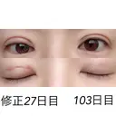 二重埋没 / 目元修正 湘南美容クリニック 広島院 DAY 27 サムネイル用