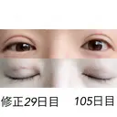 二重埋没 / 目元修正 湘南美容クリニック 広島院 DAY 29 サムネイル用