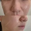 毛穴洗浄（ハイドラフェイシャルなど） / ポテンツァ ルラ美容クリニック 京都院 AFTER サムネイル用