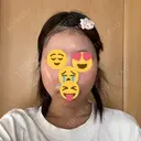 糸リフト / 脂肪吸引（顔） / ヒアルロン酸注入（あご） Wing clinic 豊中駅前院 DAY 3 サムネイル用