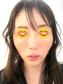 ヒアルロン酸注入（頬） 百人町アルファクリニック DAY 4 サムネイル用