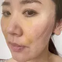 糸リフト / 脂肪吸引（顔） 札幌美容外科ネビュラクリニック DAY 5 サムネイル用