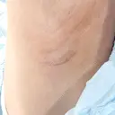 豊胸（シリコンバッグ） / その他（胸） / 乳頭縮小 ルーチェクリニック 銀座院 DAY 99 サムネイル用