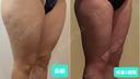 脂肪吸引（顔） / 脂肪吸引（脚） / 脂肪吸引（お尻） GAYA body design clinic DAY 22 サムネイル用