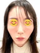 ヒアルロン酸注入（頬） 百人町アルファクリニック DAY 5 サムネイル用