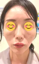 ヒアルロン酸注入（頬） 百人町アルファクリニック DAY 6 サムネイル用