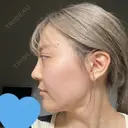 クマ治療 / リジュラン エートップ美容整形外科 DAY 27 サムネイル用
