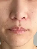 人中短縮 / 小鼻縮小（非切開） 湘南美容クリニック 仙台院 DAY 63 サムネイル用