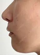 人中短縮 / 小鼻縮小（非切開） 湘南美容クリニック 仙台院 DAY 63 サムネイル用