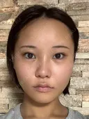 糸リフト / 脂肪吸引注射（顔） 札幌美容外科ネビュラクリニック AFTER サムネイル用