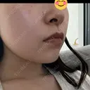 エレクトロポレーション / 光治療（フォトフェイシャルなど） / ピーリング（ハリ・ツヤ） トラスト美容クリニック 銀座院 DAY 0 サムネイル用