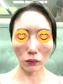 ヒアルロン酸注入（頬） 百人町アルファクリニック DAY 7 サムネイル用