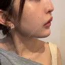 ヒアルロン酸注入（あご） DMTC CLINIC 日本橋院 DAY 1 サムネイル用