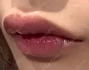 ヒアルロン酸注入（唇） 目白ホワイトクリニック DAY 0 サムネイル用