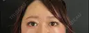 二重埋没 / 眼瞼下垂（切開） / 上まぶたの脂肪取り 藤・ナチュレ美容クリニック 銀座院 AFTER サムネイル用