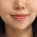 脂肪吸引（顔） ネビュラクリニック 京都院 DAY 2 サムネイル用