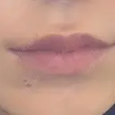 ボトックス（口角） mimi CLINIC DAY 1 サムネイル用