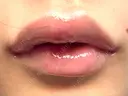 ヒアルロン酸注入（唇） 目白ホワイトクリニック DAY 1 サムネイル用