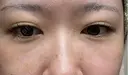 クマ治療 / 下まぶたたるみ取り / 下まぶたの脂肪取り APOLLO BEAUTY CLINIC DAY 12 サムネイル用