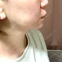 脂肪溶解注射（顔） 麻布十番クレールデンタルクリニック AFTER サムネイル用