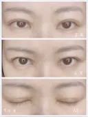 二重埋没 共立美容外科 新宿本院 DAY 6 サムネイル用