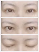 二重埋没 共立美容外科 新宿本院 DAY 9 サムネイル用