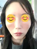 ヒアルロン酸注入（頬） 百人町アルファクリニック DAY 8 サムネイル用