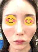 ヒアルロン酸注入（頬） 百人町アルファクリニック DAY 9 サムネイル用