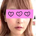 ヒアルロン酸注入（唇） 目白ホワイトクリニック DAY 0 サムネイル用