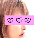 ヒアルロン酸注入（唇） 目白ホワイトクリニック DAY 0 サムネイル用