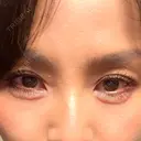 ヒアルロン酸注入（涙袋） / ボトックス（あご） ルラ美容クリニック 池袋院 DAY 3 サムネイル用