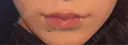 ボトックス（口角） mimi CLINIC AFTER サムネイル用
