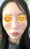 ヒアルロン酸注入（頬） 百人町アルファクリニック AFTER サムネイル用