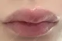 ヒアルロン酸注入（唇） 目白ホワイトクリニック AFTER サムネイル用