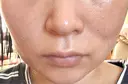 糸リフト / バッカルファット除去 / ボトックス（エラ・小顔） / ヒアルロン酸注入（頬） / フラクショナルレーザー（毛穴・ニキビ跡） TCB東京中央美容外科 仙台駅前院 DAY 26 サムネイル用