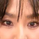 ヒアルロン酸注入（涙袋） / ボトックス（あご） ルラ美容クリニック 池袋院 DAY 4 サムネイル用