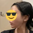 その他（輪郭） / 医療痩身（顔） / その他（肌） / RF（高周波）たるみ治療 ライブリークリニック 浜松町院 DAY 0 サムネイル用
