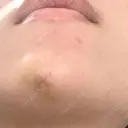 ボトックス（あご） / ヒアルロン酸注入（あご） TCB東京中央美容外科 梅田茶屋町院 DAY 6 サムネイル用