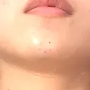 ボトックス（あご） / ヒアルロン酸注入（あご） TCB東京中央美容外科 梅田茶屋町院 DAY 0 サムネイル用