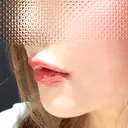 ヒアルロン酸注入（唇） 目白ホワイトクリニック DAY 3 サムネイル用