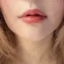 ヒアルロン酸注入（唇） 目白ホワイトクリニック DAY 3 サムネイル用